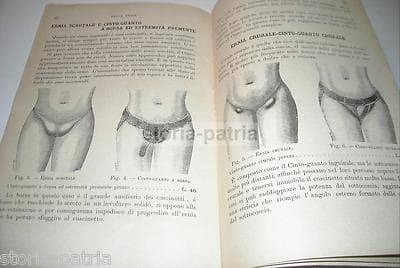 Medicina, Chirurgia, Sanitaria: Ernie Inguinali, Ventriere, Cinti Erniari   Pubblicità