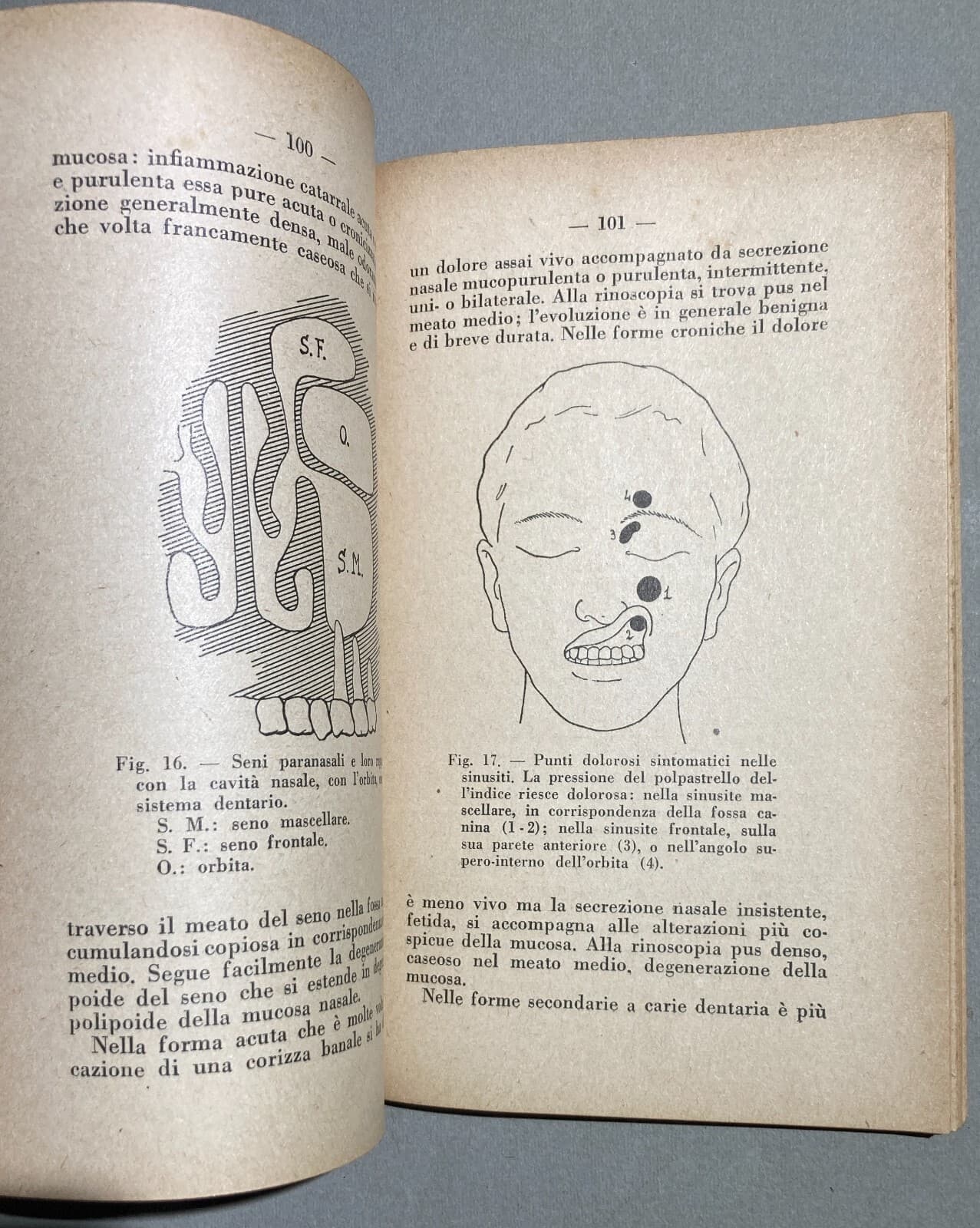 Medicina: Otorinolaringoiatria (naso, Faringe, Laringe, Otiti, Faringiti). Sanvenero Rosselli, 1930