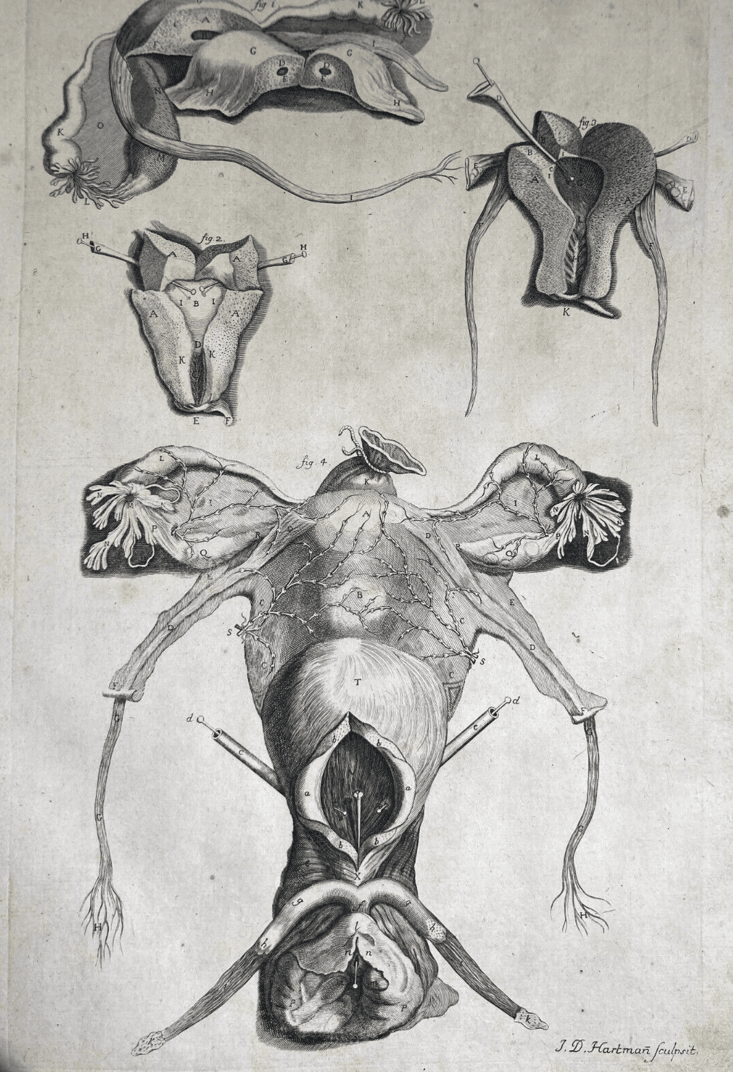 Medicina: Anatomia Umana, Ginecologia, Utero E Ovaie. Incisione Di Hartman, XVIII Secolo