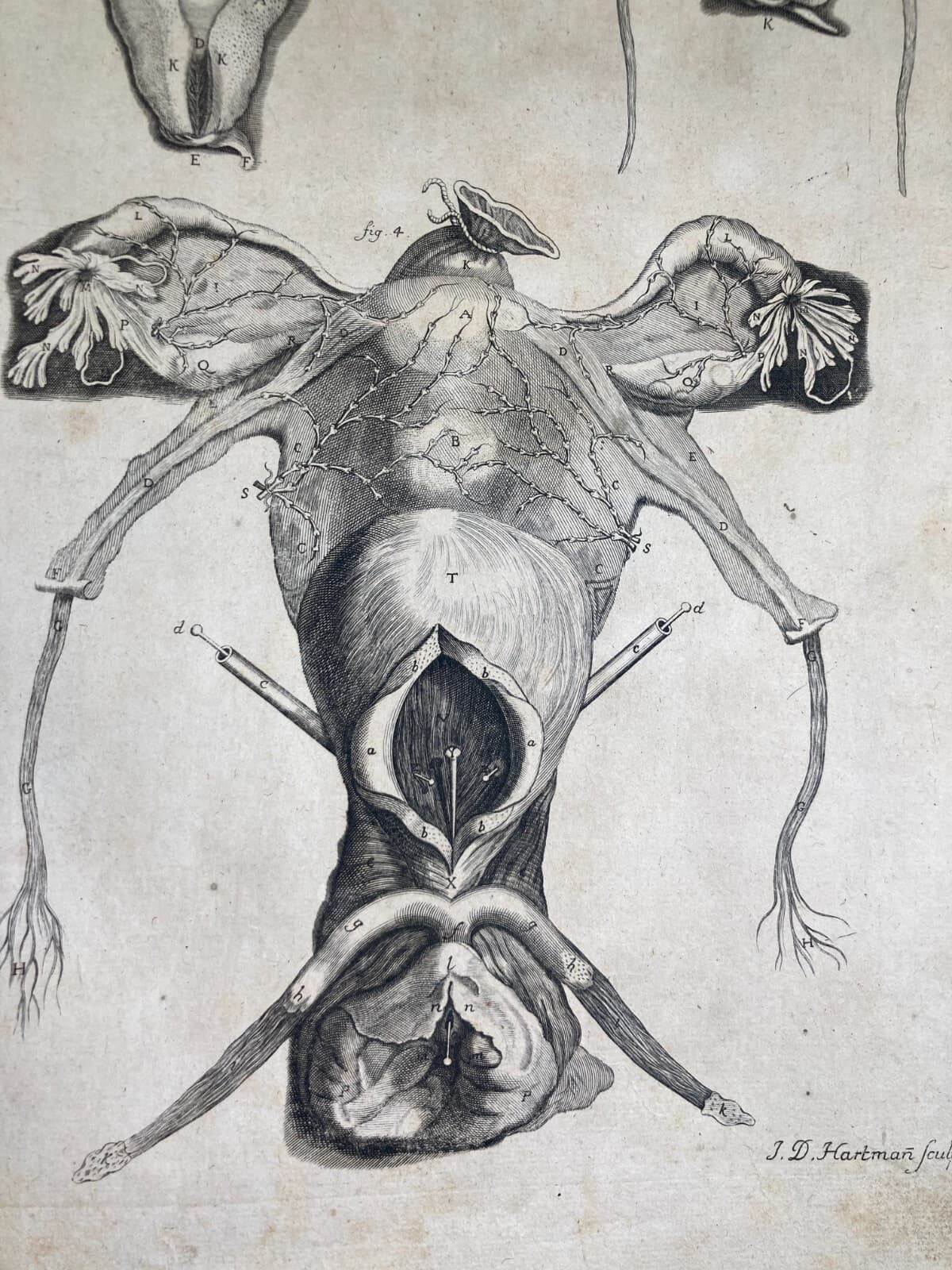 Medicina: Anatomia Umana, Ginecologia, Utero E Ovaie. Incisione Di Hartman, XVIII Secolo