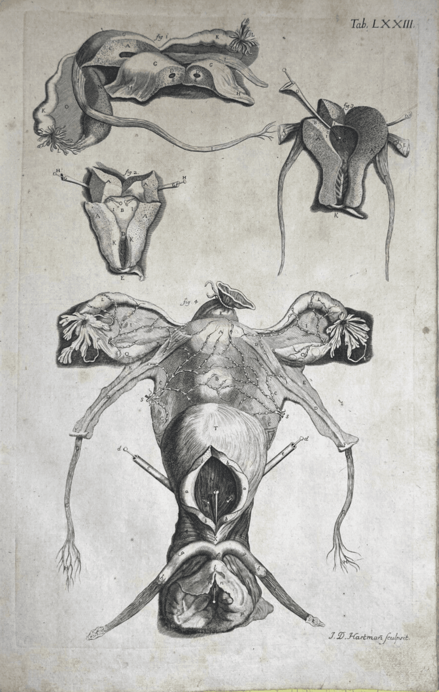 Medicina: Anatomia Umana, Ginecologia, Utero E Ovaie. Incisione Di Hartman, XVIII Secolo