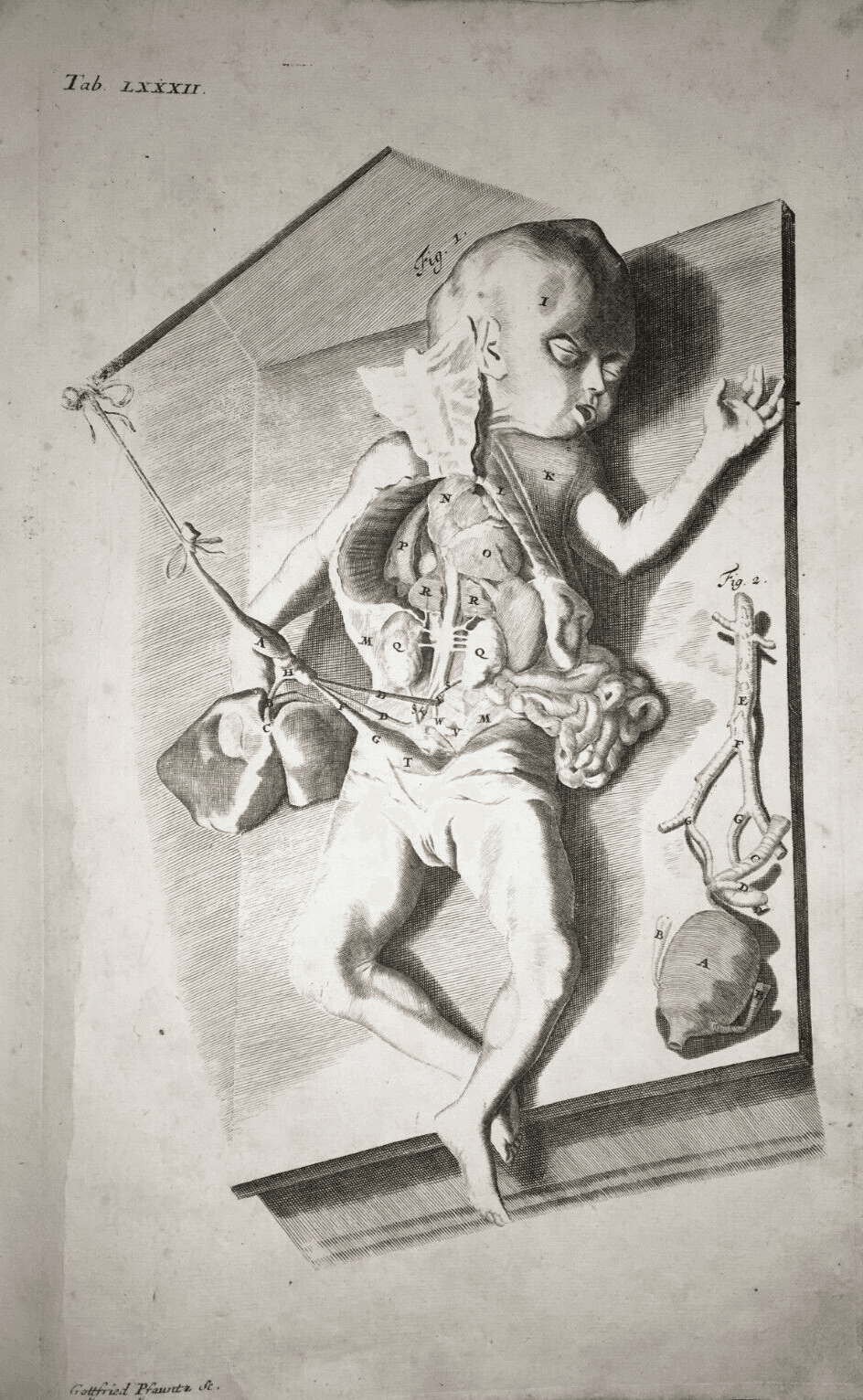 Medicina, Pediatria, Apparato Intestinale, Addome Aperto: Antica Rara Incisione Del '700