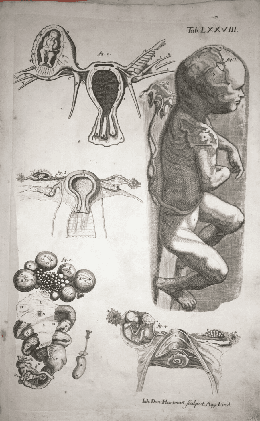 Medicina, Pediatria, Ostetricia, Ginecologia: Incisione Antica Di Feto, Hartmann, XVIII Secolo.