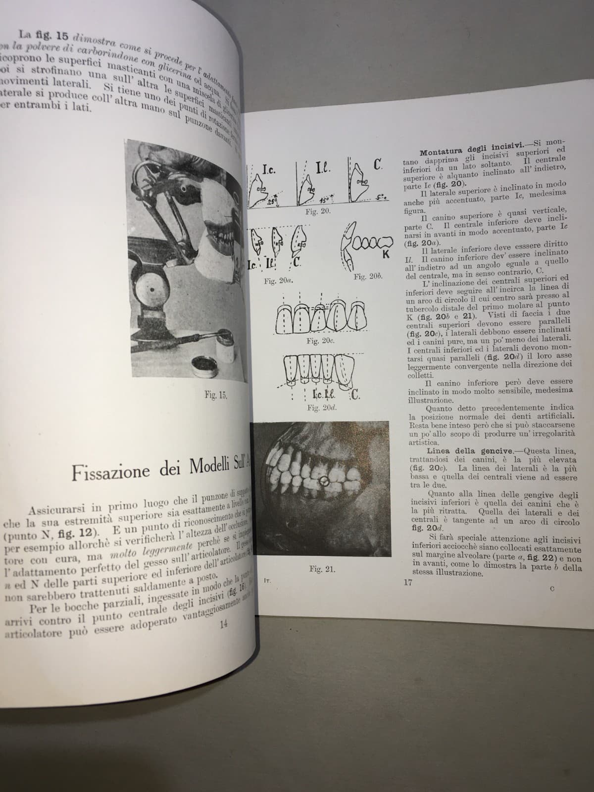 Montaggio Di Apparecchi Con Denti Anatoform E Blocchi Gysi. Metodo Del Dr. Gysi (Anni '30)