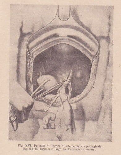 L'Intervento Chirurgico Nelle Salpingiti   V. Criscuoli (1926)