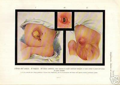 Trattato Di Pediatria Pfaundler Schlossmann 1913 Vol. 1