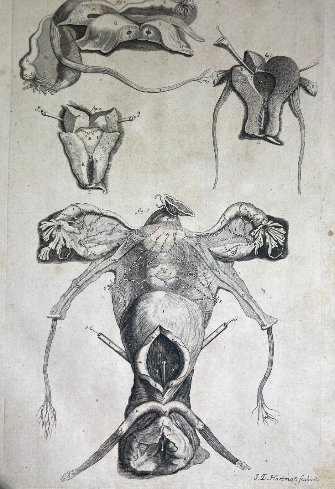 Medicina: Anatomia Umana, Ginecologia, Utero E Ovaie. Incisione Di Hartman, XVIII Secolo