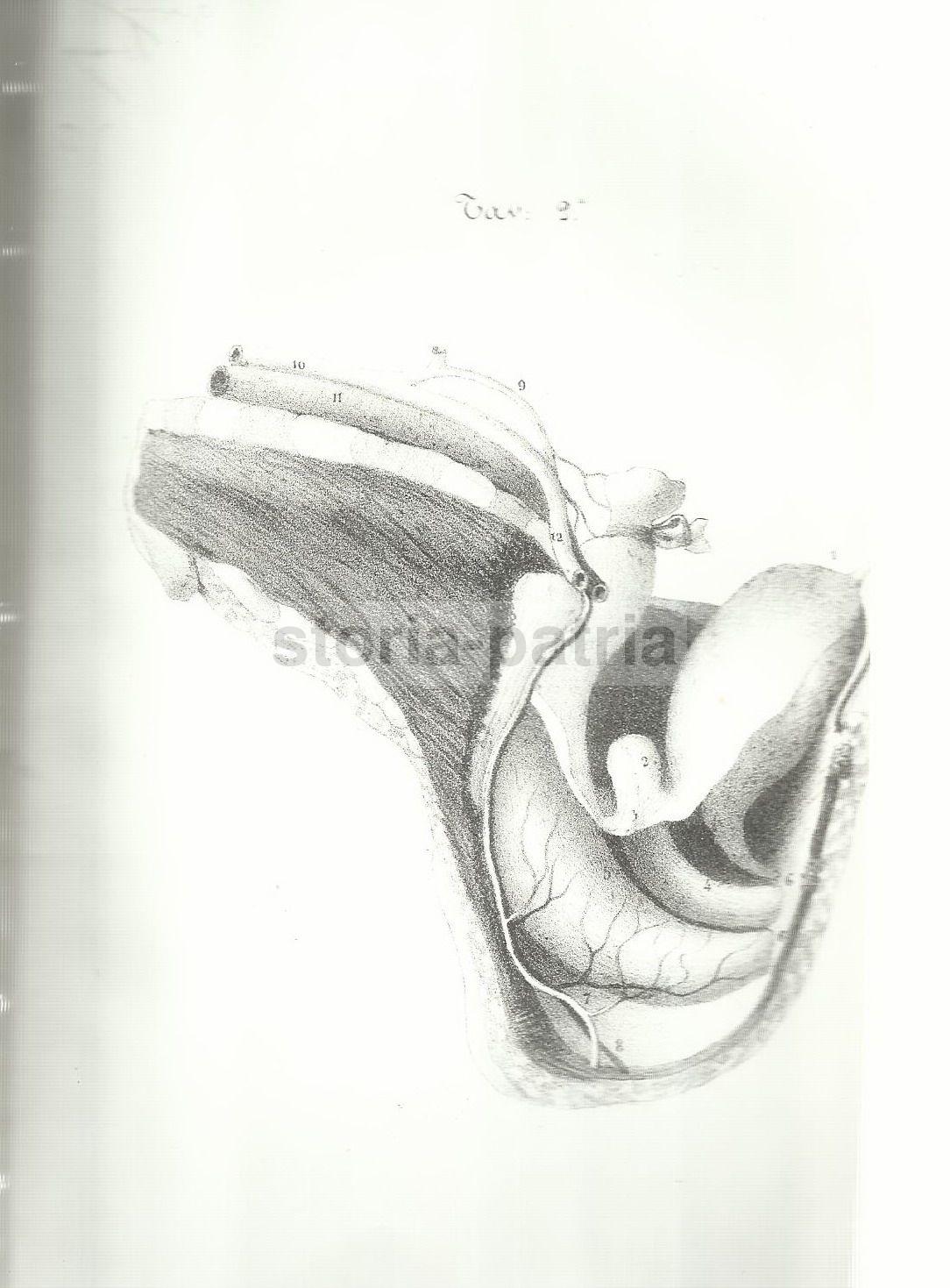 Medicina, Ginecologia, Chirurgia, Anatomia Patologica, Rara Deformazione, Napoli, 1847 immagine 2